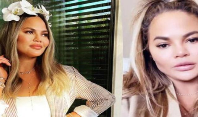 Chrissy Teigen yanaklarındaki yağları aldırdı