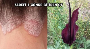 Sedef Hastalığının Düşmanı: Yabani Pancar Kökü