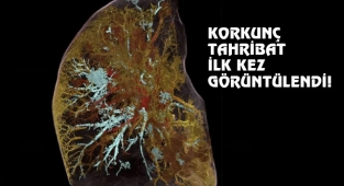 Covidden Ölen Birinin Akciğer Görüntüsü Yayınlandı