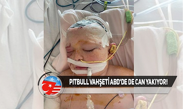 ABD'de 11 Yaşındaki Çocuğa Üç Pitbull Saldırdı