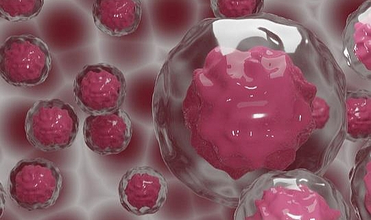 Kanser Hastası Kök Hücre Nakliyle  HIV'den Kurtuldu
