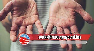 ABD'de Kızamık Salgını Uyarısı