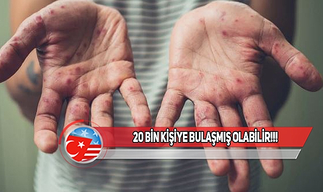 ABD'de Kızamık Salgını Uyarısı