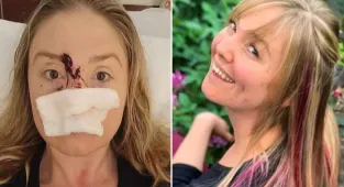 Dog startled by teeth whitener before biting woman's nose off