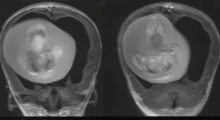 Fetus of twin surgically removed from BRAIN of one-year-old in China