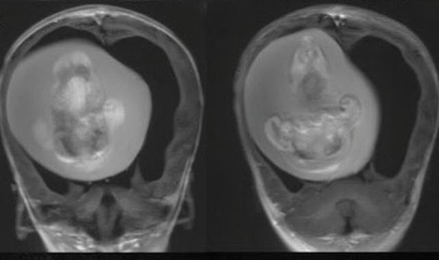 Fetus of twin surgically removed from BRAIN of one-year-old in China