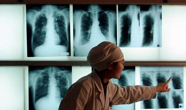 Verem Tedavisini Reddeden Hastaya Tutuklama Kararı 