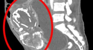 Woman, 50, in Africa dies after 'stone baby' blocked her intestine