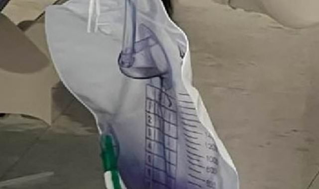 Woman's urine turns PURPLE after rare side effect of constipation,UTI 