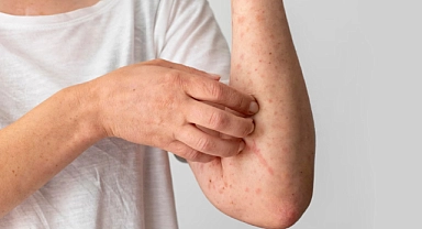 CDC ve DSÖ’den korkutan açıklama: Kızamık kaynaklı ölümlerde artış!