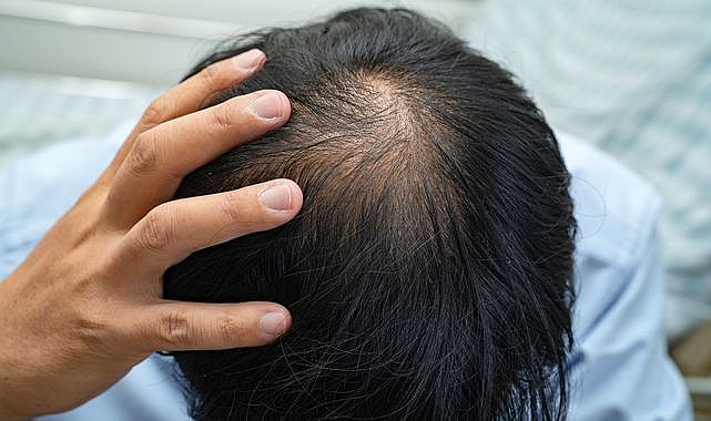 Türk akademisyenler yapay zeka destekli "Ke-Bot" cihazıyla saç ekimini devrimsel hale getirdi