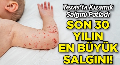 Texas'ta Kızamık Salgını Patladı: Son 30 Yılın En Büyük Salgını!