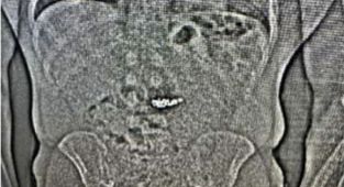 Diamond earrings swallowed by suspect recovered two weeks later
