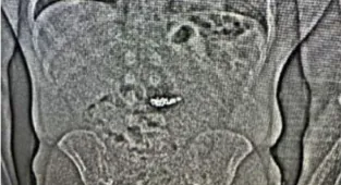 Diamond earrings swallowed by suspect recovered two weeks later