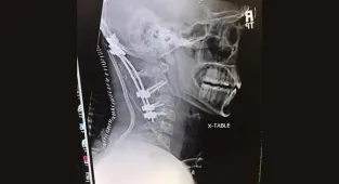 Doctors reattached my head after I was 'decapitated' in a car accident
