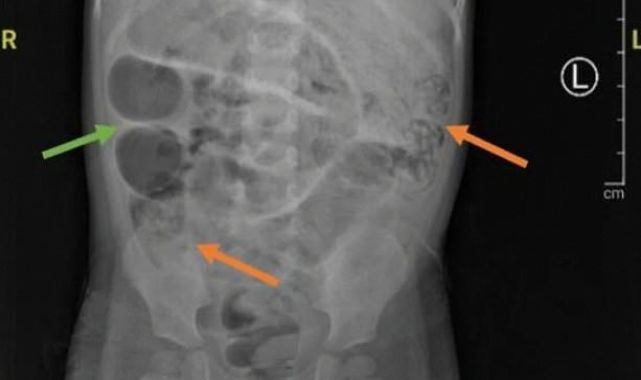 Horrifying images of giant WORMS being removed from young boy's body
