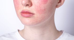 The little-known treatments that really help rosacea, tells DR ELLIE