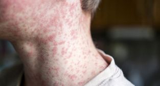 Two kids have died in the Texas measles outbreak. Could that happen here?