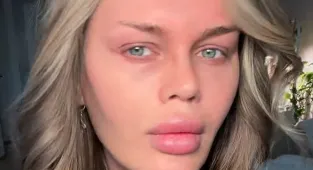 YouTube star details blepharoplasty's gory aftermath, reveals eyelids