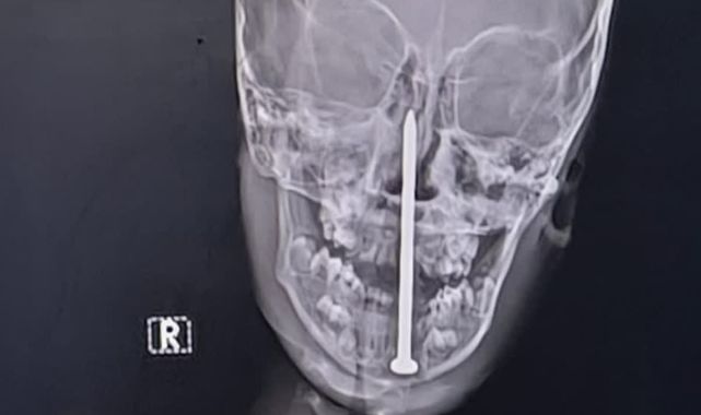 Boy, seven has three-inch nail removed from his BRAIN