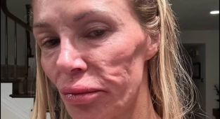 Brandi Glanville reveals impact of her disfigured face on her sex life