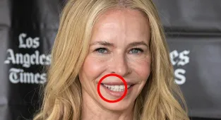 Doctors warn 'Ozempic teeth' is latest horrifying  side effect