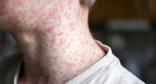 Fears of outbreak after spectator falls ill at baseball game
