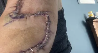 The 'normal' mole on mother's arm that turned out to be skin cancer