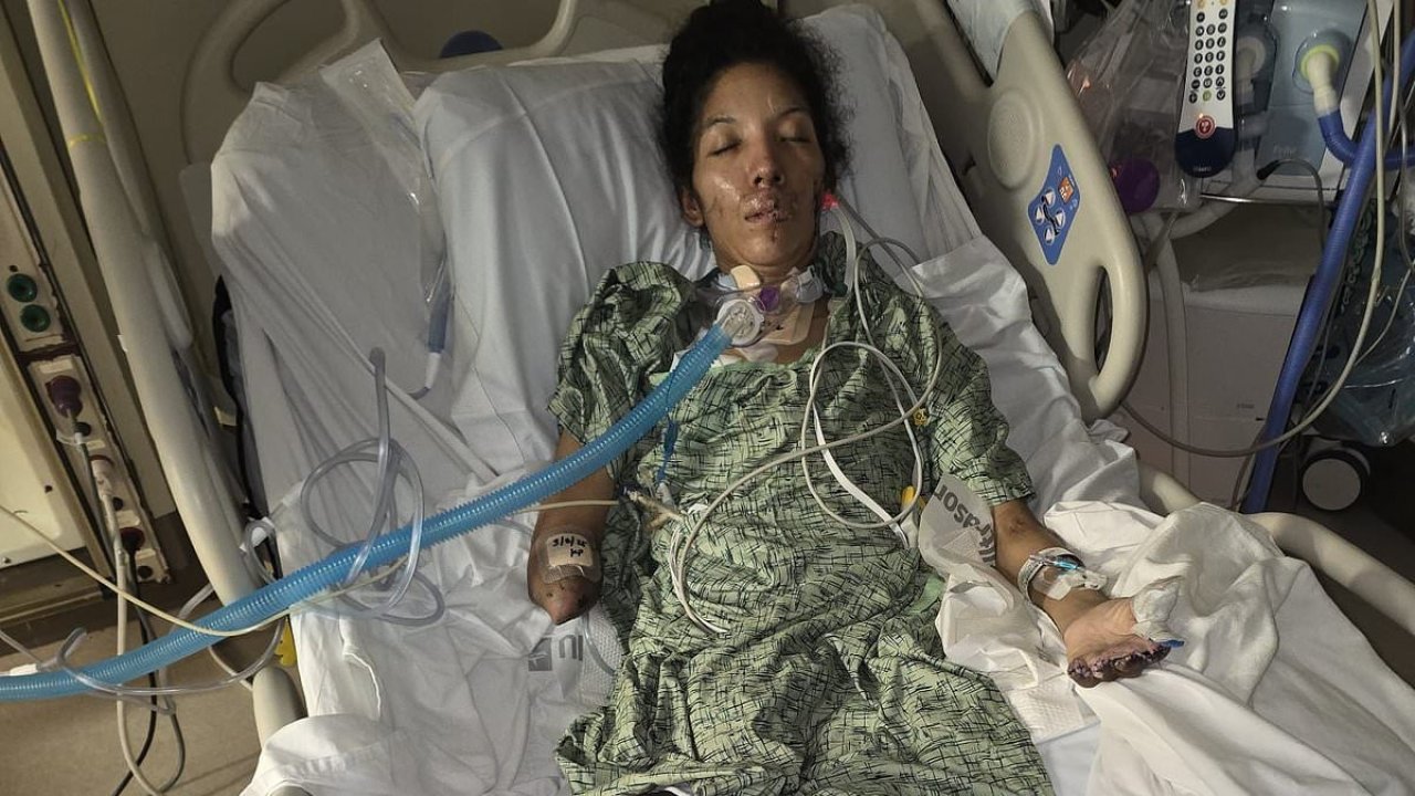 Mom has all of her limbs amputated after catching infection