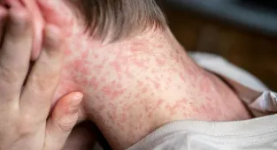 US counties where world's most infectious disease is set to surge