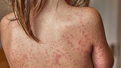 America's measles outbreak hits terrifying milestone