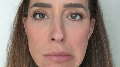 I got Botox on half my face to show others how it affects your looks