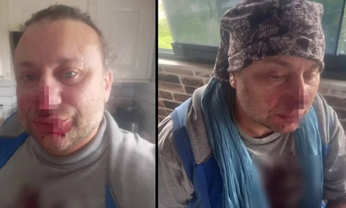 Köpek ısırmıştı! Onur Akay yoğun bakımda