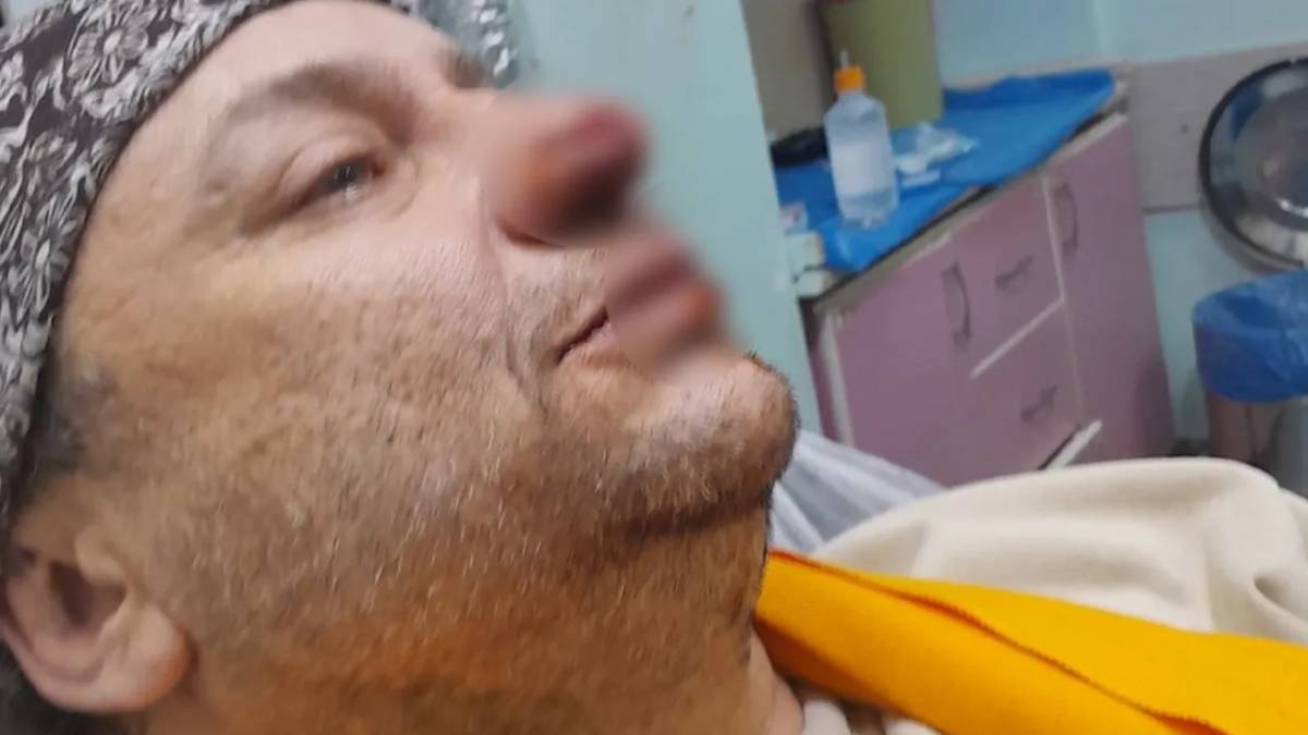 Köpek ısırmıştı! Onur Akay yoğun bakımda