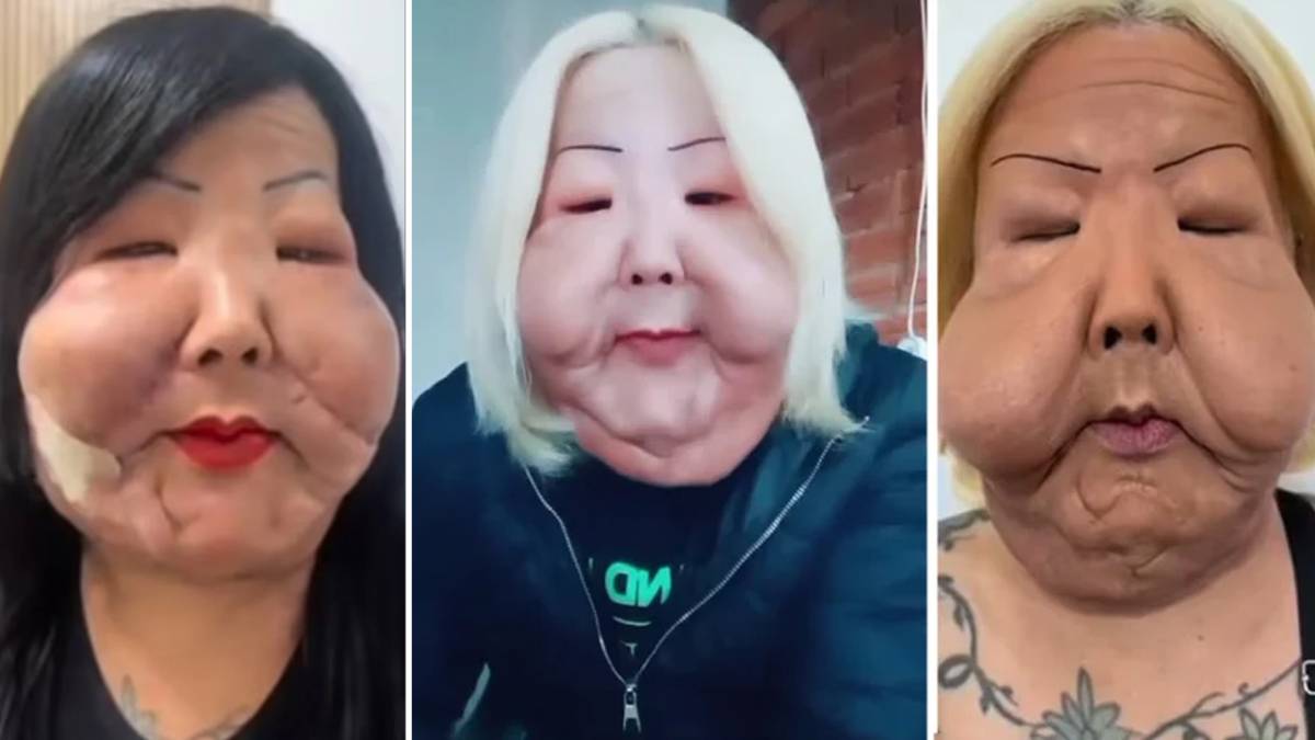 Estetik hayali kabusa dönüştü! Güzellik uğruna yüzü tanınmaz hale geldi